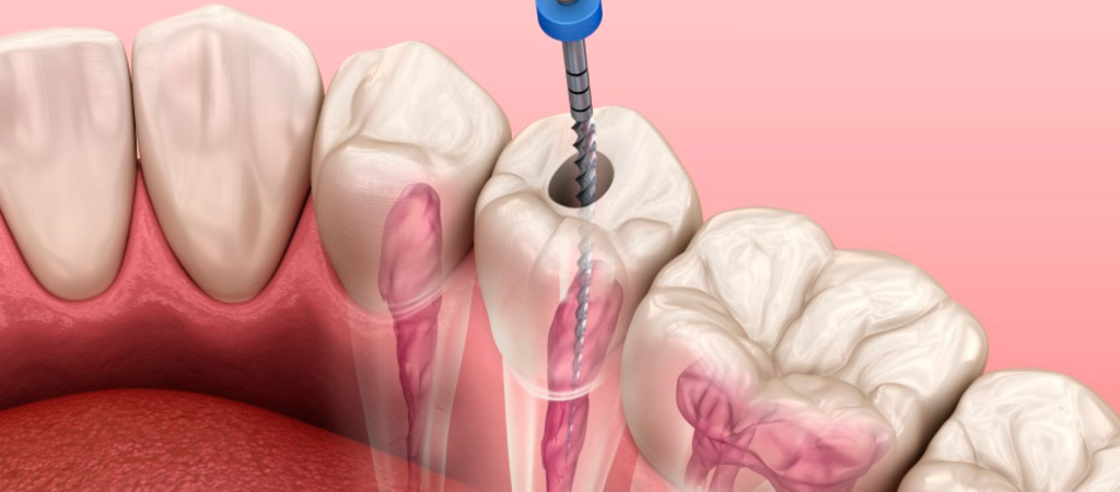 Чистка Air Flow в стоматологии «Новый Век»: отзывы до и после процедуры